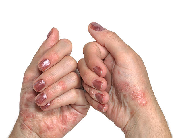 skin diseases eczema