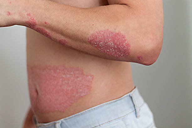 Skin Diseases psoriasis