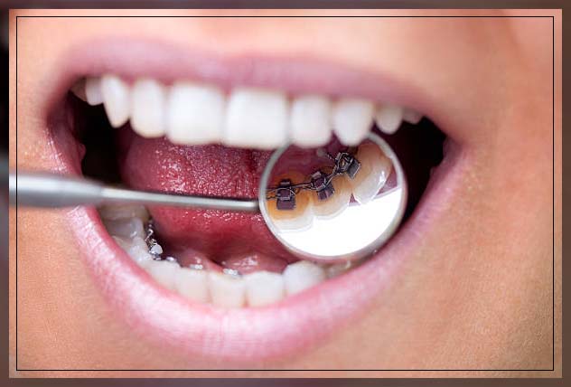 woman with different types of teeth braces