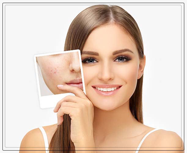 Acne scars 12