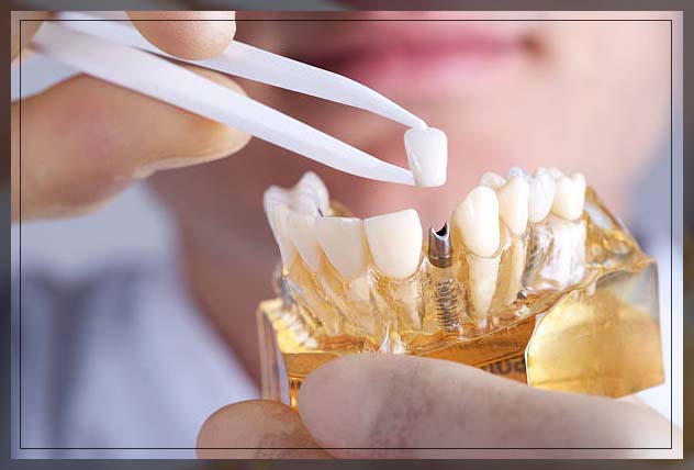 Dental implants 14