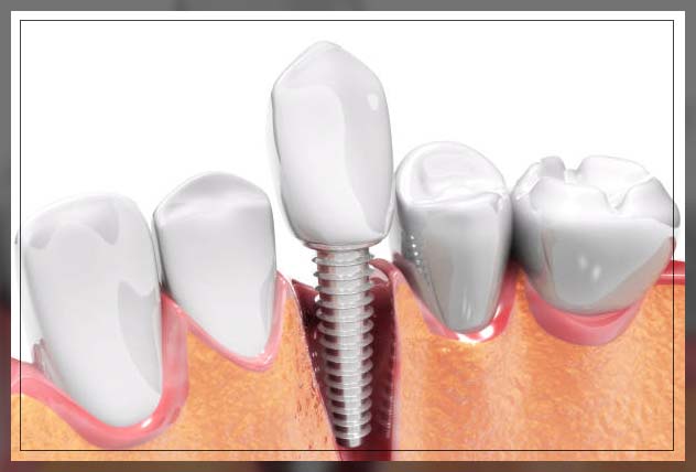 Dental implants 15