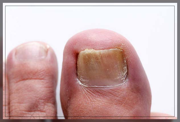 Fungal infection skin 16