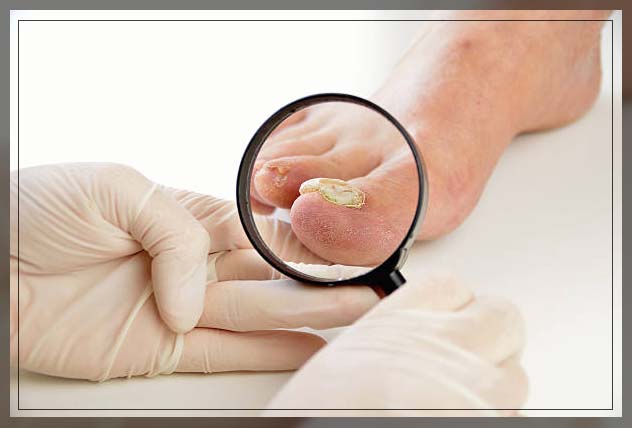 Fungal infection skin 18