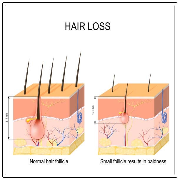 alopecia areata 1