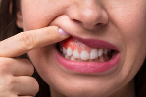 teeth picking impact on gums