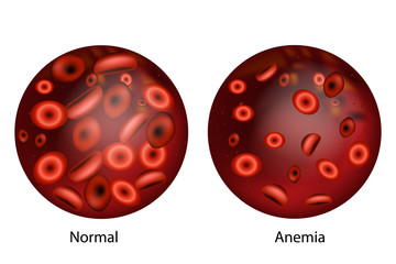 anemia signs to watch out for