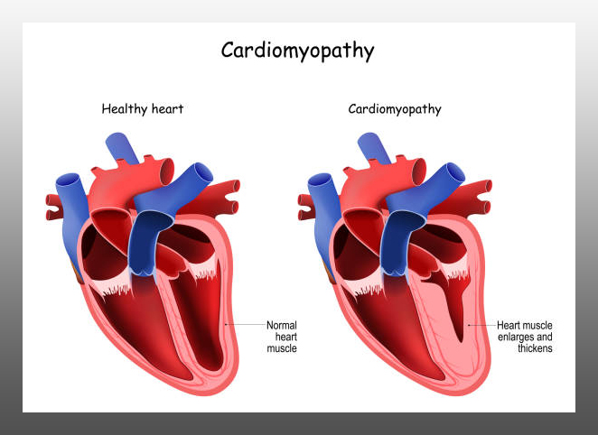 Cardiomyopathy