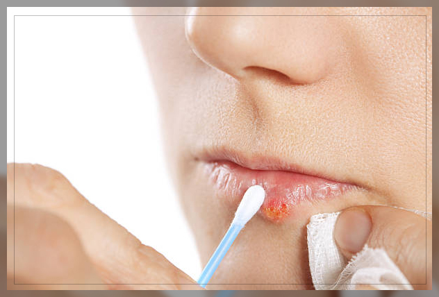 Cold Sores 16