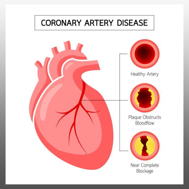 Coronary artery disease