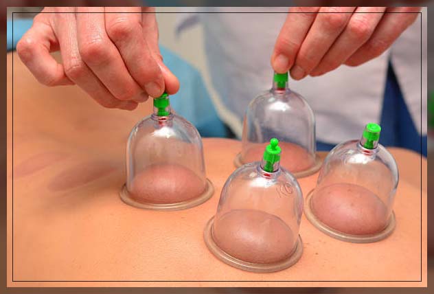 Cupping benefits 16