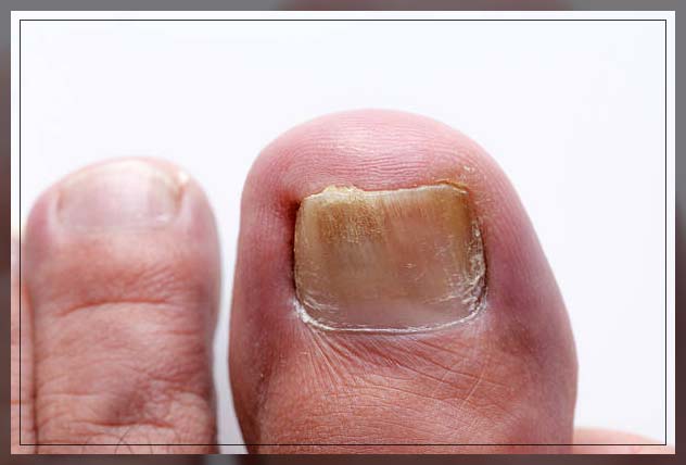 Fungal Skin Infection 16