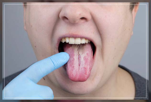 Oral Thrush Symptoms Causes And Treatment Repc