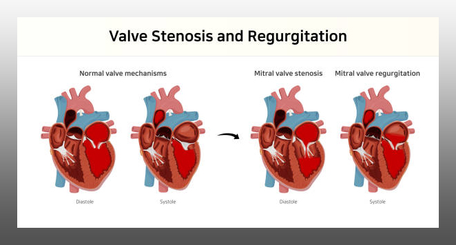 Valvular heart disease