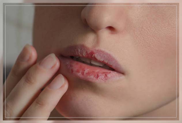 dry mouth symptoms cracked lips