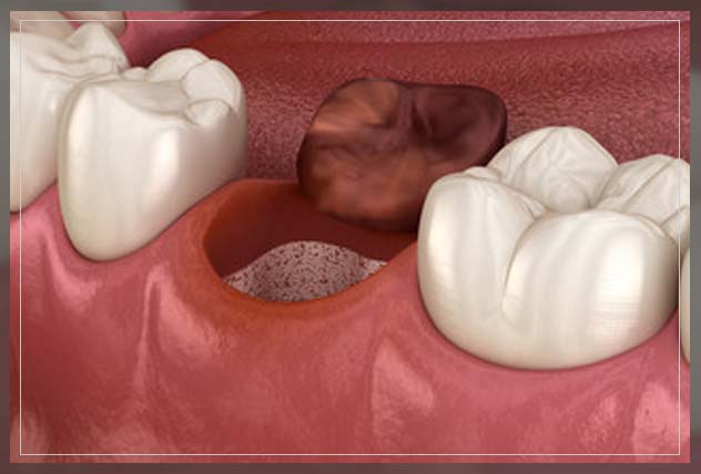 this is a complete dry socket guide