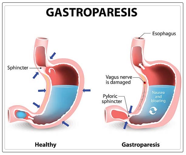 gastroparesis