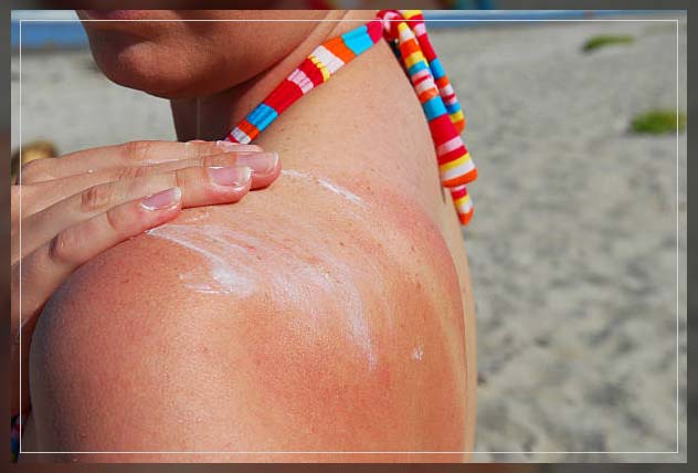 woman applying heat rash cream