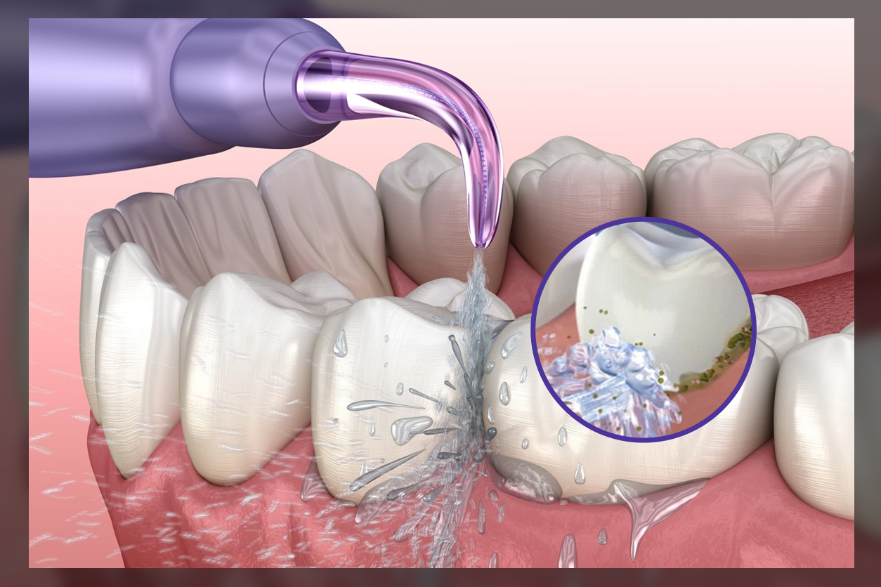 understanding water flossing