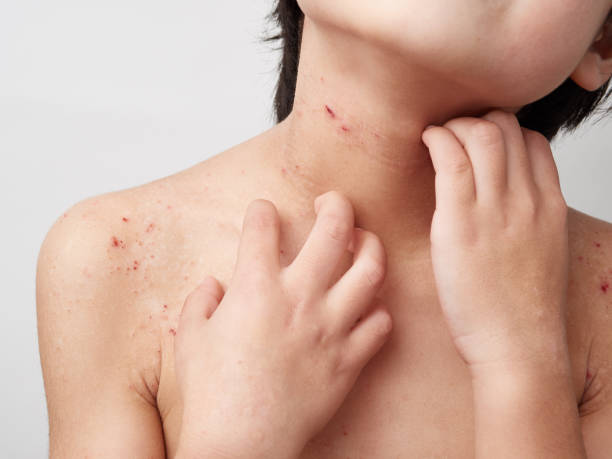 dermatitis on skin