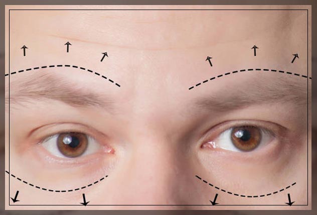 Eyebrow Lift 1