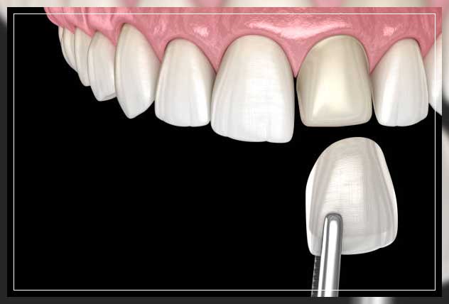 Porcelain veneer 6