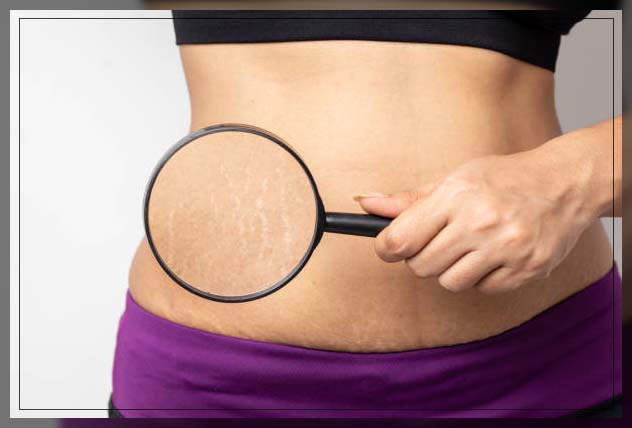 Stretch Mark Removal 12