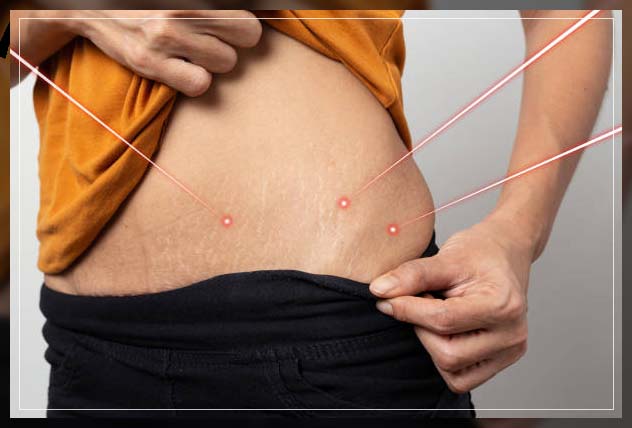 Stretch Mark Removal 17