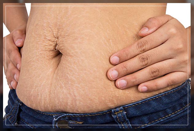 Stretch Marks 3