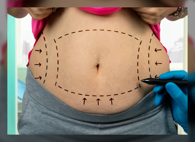 Tummy tuck 3