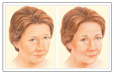 brow lift surgery