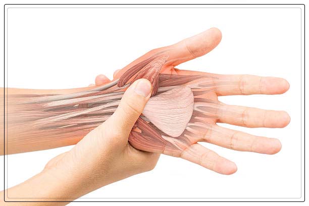 carpal tunnel syndrome
