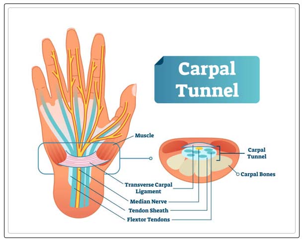carpel tunnel syndrome causes