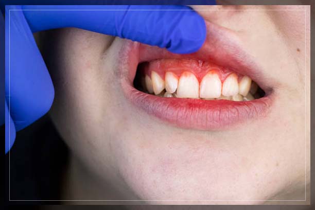 gum bleeding in gingivitis