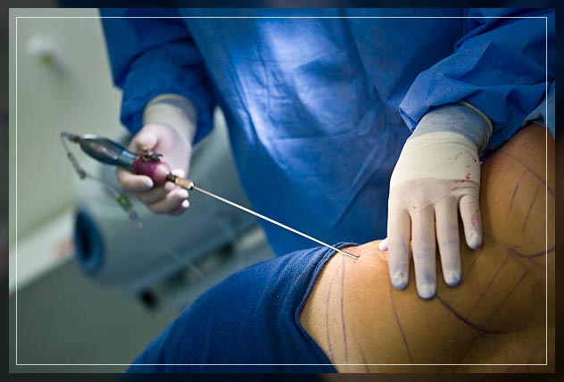 liposuction in dubai