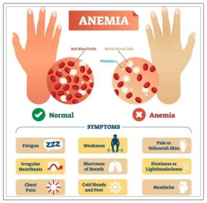 a complete overview of iron deficiency anemia 