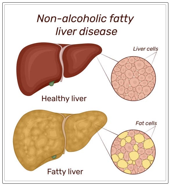 types of fatty liver