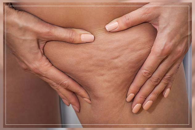 Cellulite treatment 6