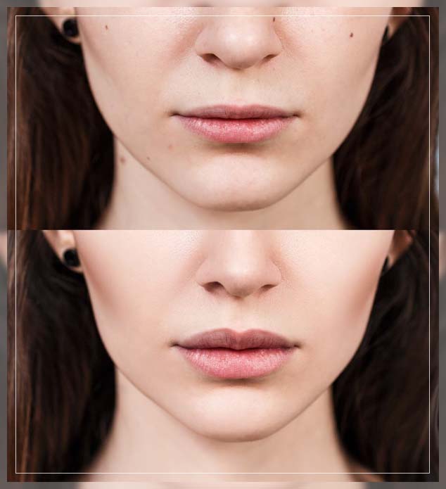 Juvederm Filler Procedure, Benefits and More REPC
