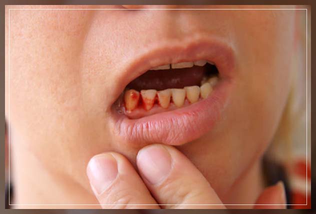 getting an overview of bleeding gums causes