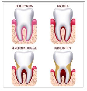 how teeth get impacted with gingivitis 