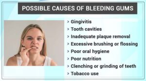 a few common causes of bleeding gums