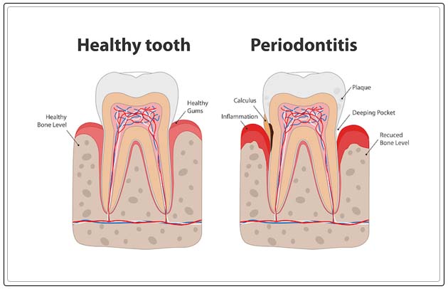 bleeding gums treatment