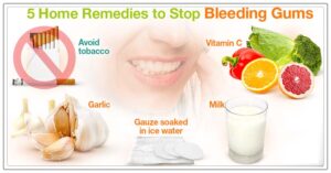 what is causing bleeding gums 