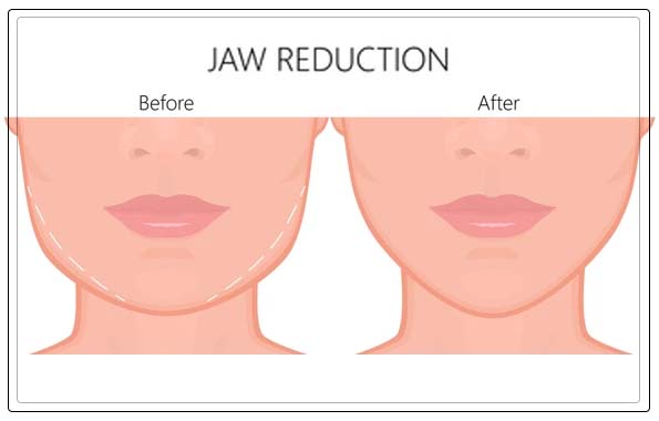 alternative reduction treatment