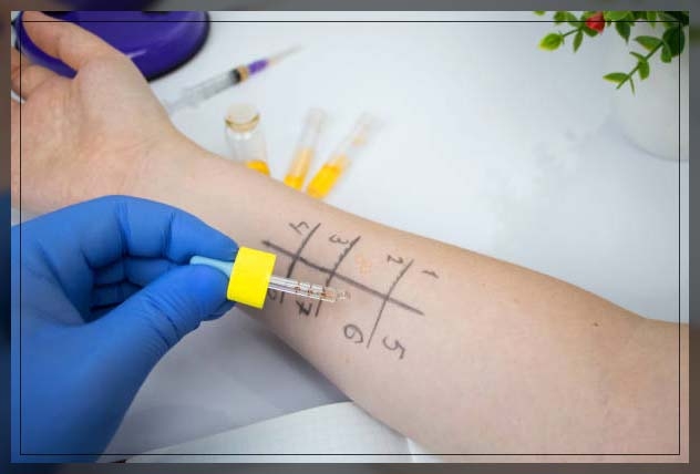 skin prick test