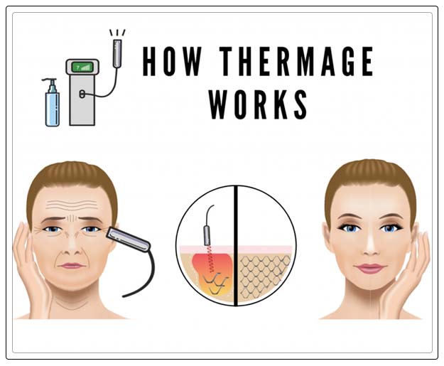 thermage dubai-procedure