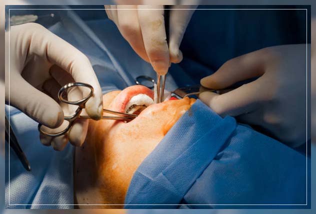 Buccal fat removal 1