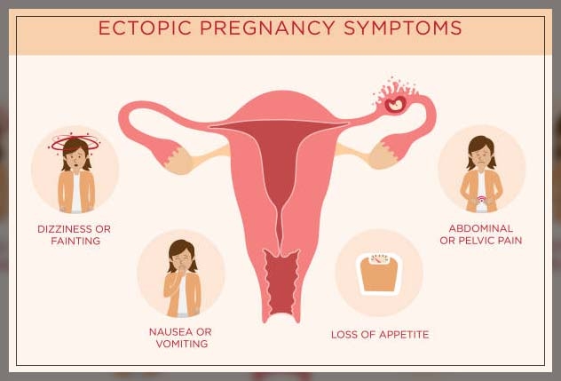 ectopic pregnancy