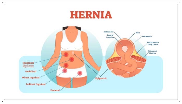 inguinal hernia 1